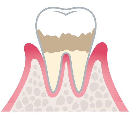 軽度歯周炎
