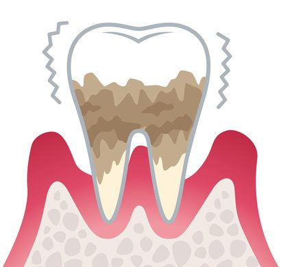 重度の歯周炎