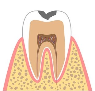 C1【エナメル質の虫歯】