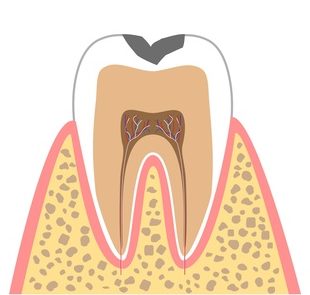 C1【エナメル質の虫歯】